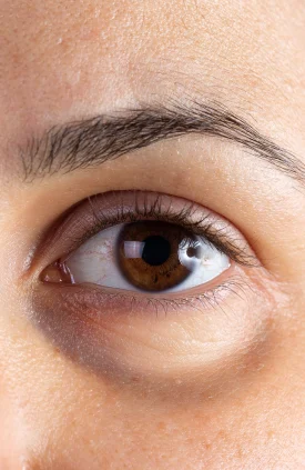 Ojeras